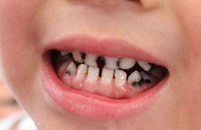牙齿黑线填充有危害吗—牙齿黑线填充有危害吗