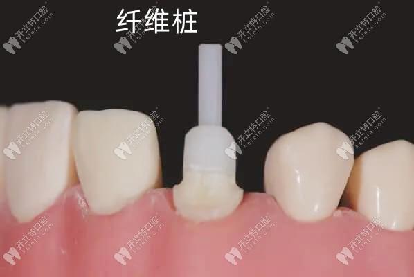 牙齿矫正牙槽骨重建需要多长时间