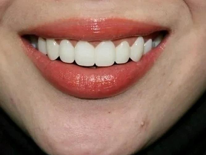 重塑美丽笑容，从牙周软组织重建开始